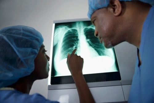 Fibrosi polmonare idiopatica, il Ministro interrogato sull’accesso al pirfenidone