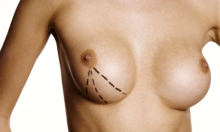 Da oggi solo i “veri” chirurghi plastici potranno aumentare il volume del seno