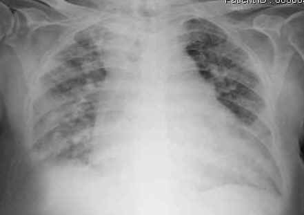 Fibrosi polmonare idiopatica, il farmaco ambriesentan non deve essere utilizzato