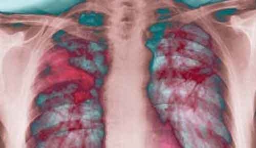 Fibrosi polmonare idiopatica, per ora nessuna speranza sul triplice regime farmacologico