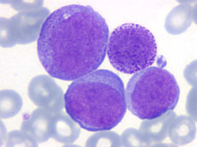 Leucemia linfoblastica acuta, vincristina liposomiale approvata negli USA
