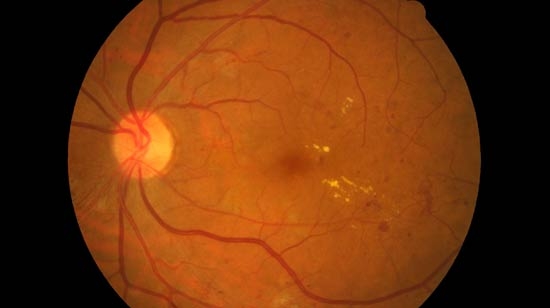 Malattie rare della retina, gli USA approvano l’impianto