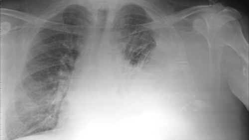 Fibrosi Polmonare Idiopatica. 500 pazienti in attesa che Aifa fissi prezzo del Pirfenidone
