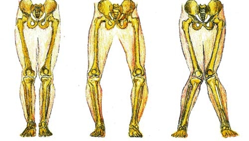 Rachitismo, studio internazionale scopre il ruolo dell’osteopontina