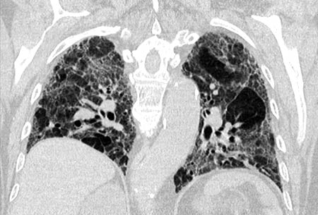 Fibrosi polmonare idiopatica, l’attesa dei pazienti ha i giorni contati