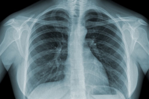 Fibrosi polmonare idiopatica. Una speranza ed un supporto per i pazienti