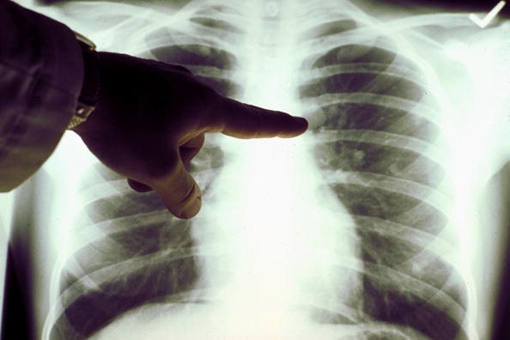 Fibrosi polmonare idiopatica, E’ tempo del registro globale