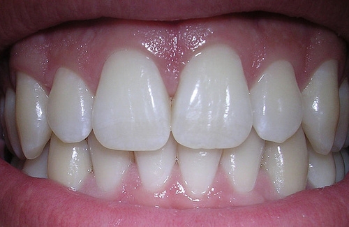 Salute, i denti possono auto-ripararsi grazie a una molecola
