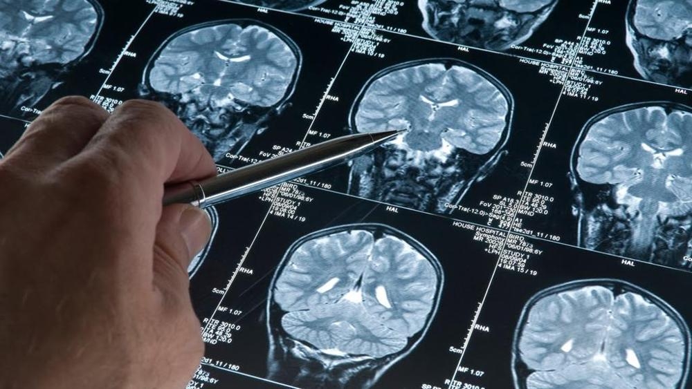 Il Cnr a capo di un gruppo di ricerca europeo per la diagnosi precoce del morbo di Alzheimer