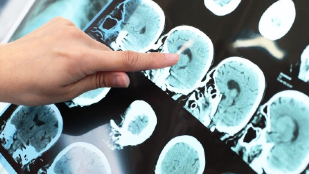 Alzheimer, il lato oscuro di APOEe4: all’Irccs Fatebenefratelli parte una nuova ricerca