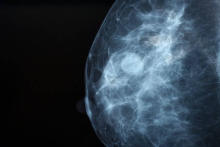 Cancro al seno. Lo screening sotto i 50 anni riduce la mortalità
