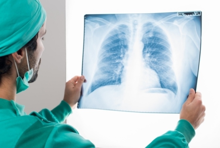 Tumore al polmone: passi avanti verso la terapia personalizzata