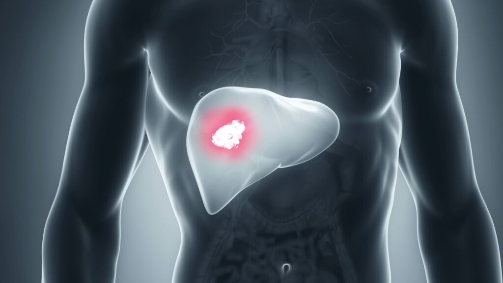 Cancro al polmone. Una nuova ricerca porta nuove speranze