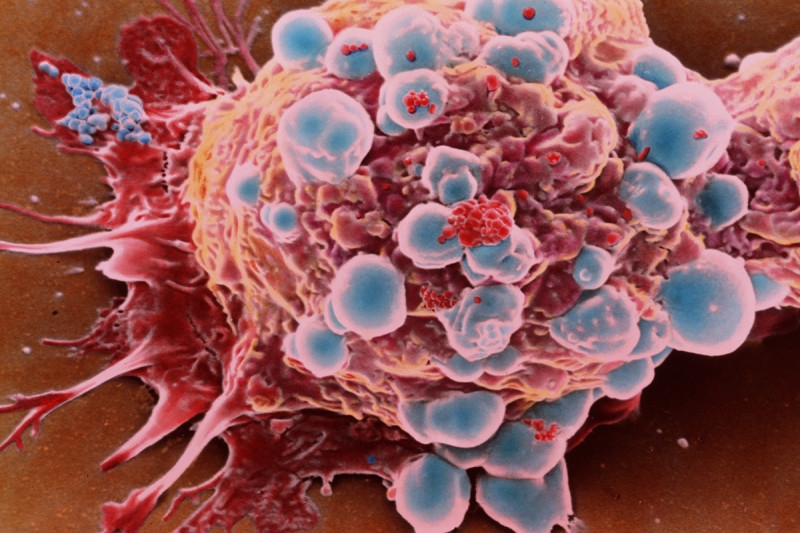 Ricerca. Cancro al seno. Ricercatori di Oxford scoprono come bloccare la riproduzione delle cellule tumorali