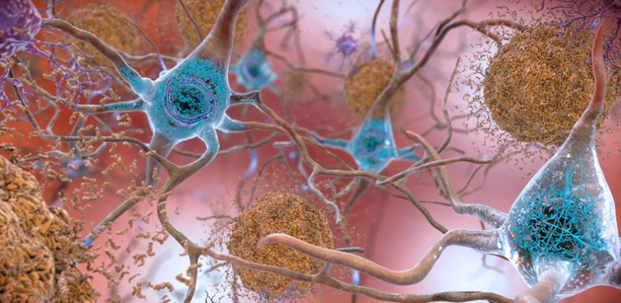 Un biosensore innovativo per riconoscere l’Alzheimer