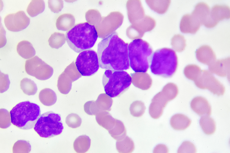 Leucemia mieloide acuta: parte la sfida delle cellule Car-Natural Killer