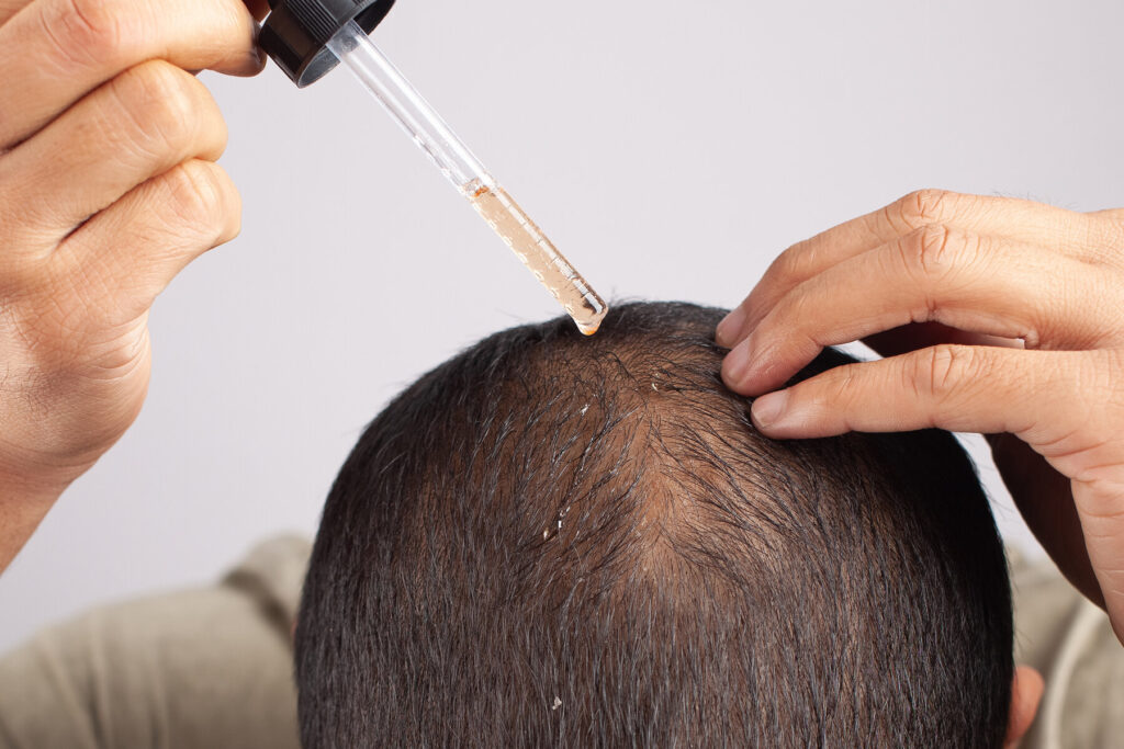 Chirurgia capelli: tipologie di trattamenti e trapianti
