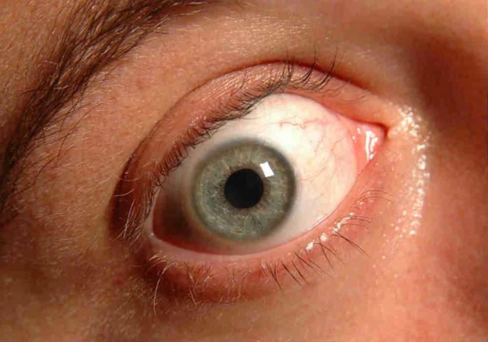 Glaucoma: la citicolina migliora la qualità di vita dei pazienti