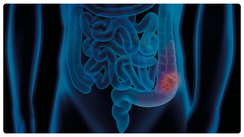 Metastasi del colon retto. Comprendere le cellule senescenti per evitarne la diffusione