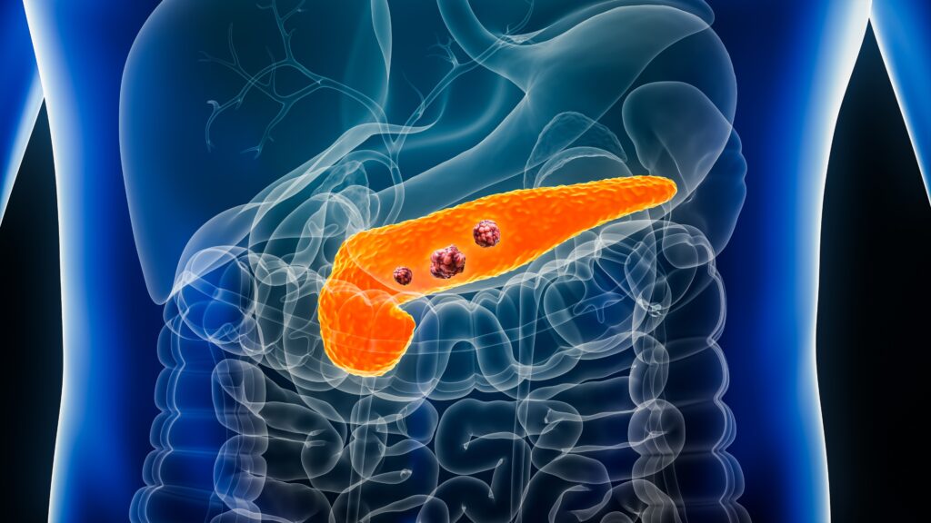 Cancro al Pancreas: Nuove scoperte sui “macrofagi IL-1ß+”