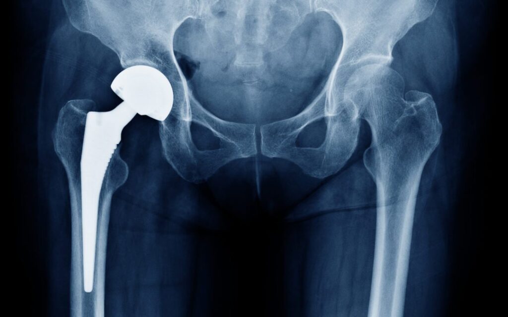 Protesi anca: per quali disturbi è indicata e come avviene l’intervento