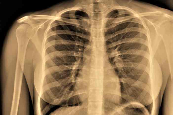 Enfisema polmonare: un nuovo trattamento migliora il respiro
