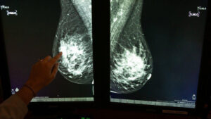Tumore al seno. La diagnosi precoce salva migliaia di vite
