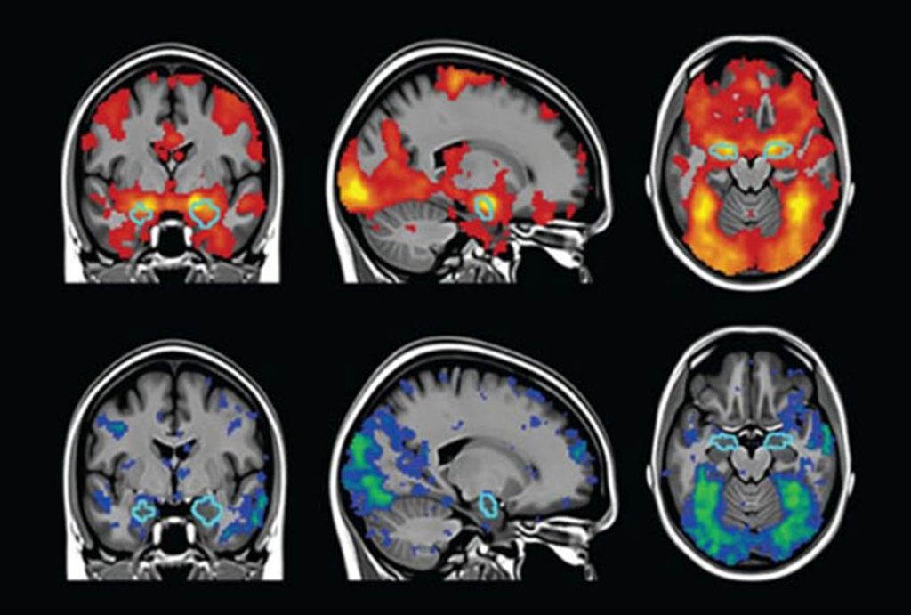 Neuroscienza: Scoperta una nuova tecnica di imaging per la diagnosi avanzata dei tumori cerebrali