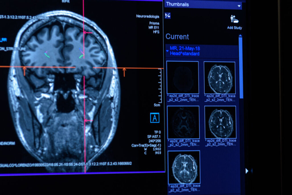 Intelligenza Artificiale e sclerosi multipla: nuovo modello anticipa la diagnosi