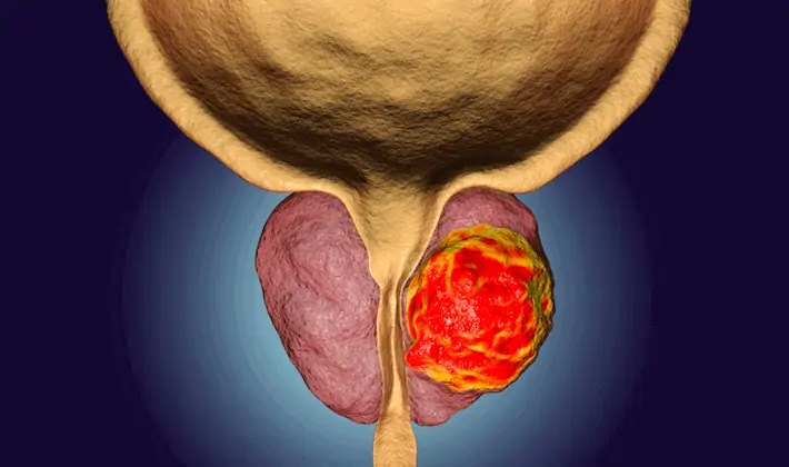 Carcinoma prostata. Al Gemelli percorso clinico assistenziale dedicato e innovativo