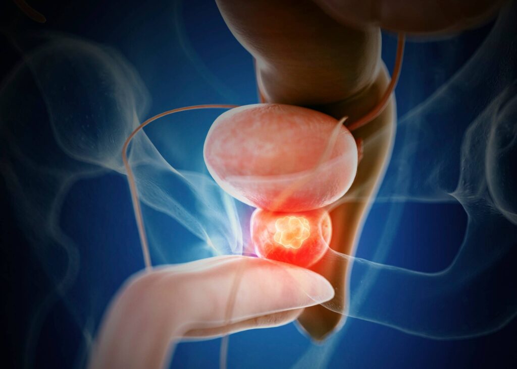 Tumore alla prostata, al Gemelli un nuovo percorso integrato per la cura