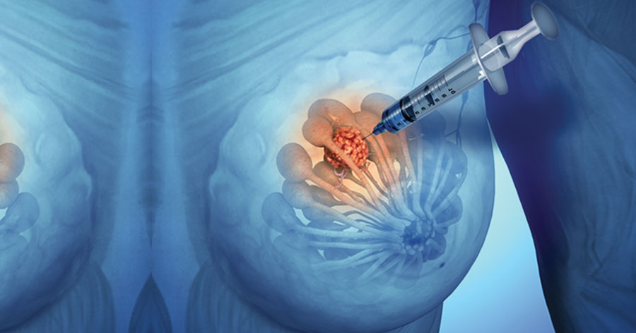 Tumore al seno. Nasce la prima task force internazionale sul carcinoma lobulare