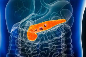 Diagnosi precoci e terapie personalizzate per la cura del tumore al pancreas