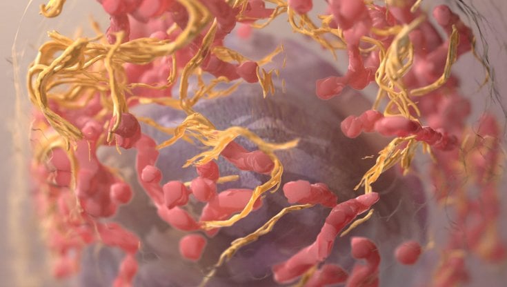 Melanoma metastatico: una nuova strategia per bloccare la sopravvivenza delle cellule tumorali nei linfonodi