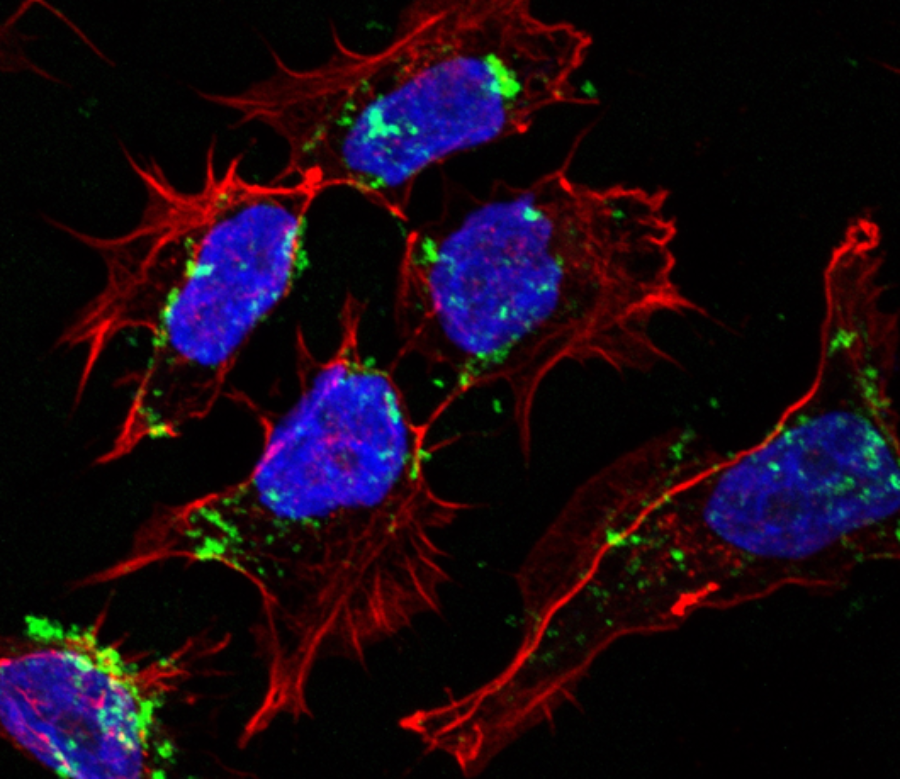 RNA non codificante e medulloblastoma: identificato un nuovo bersaglio per terapie di precisione