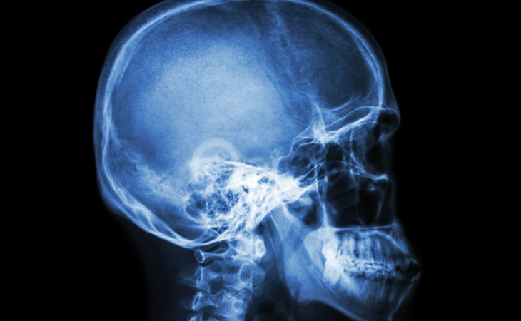 Craniosinostosi, una nuova terapia non invasiva