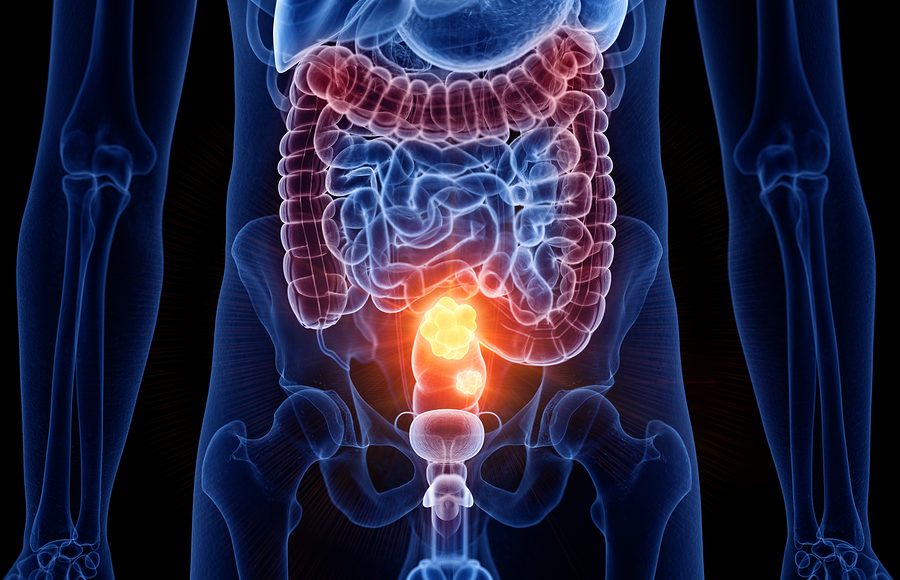 Colon-retto: Milano guida studio Ue sull’immunoterapia