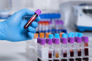 Alzheimer, un esame del sangue per individuare i primi segnali