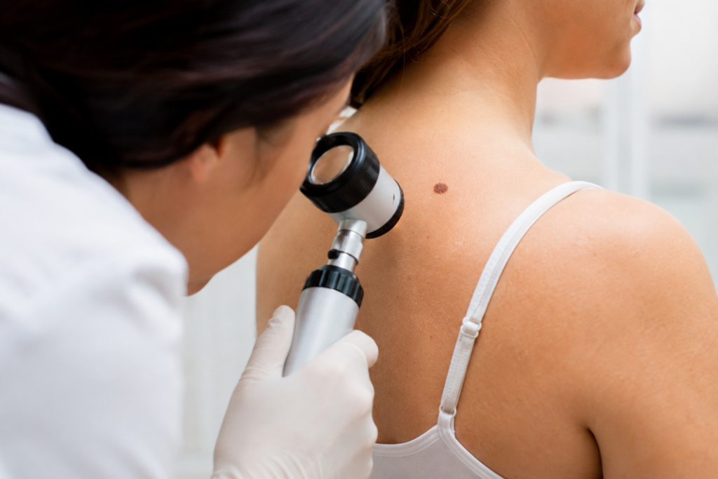 Melanoma: parte lo studio sulla superimmunoterapia” pre-operatoria