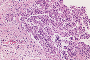 Attività fisica: l’esercizio entra nella terapia contro il cancro
